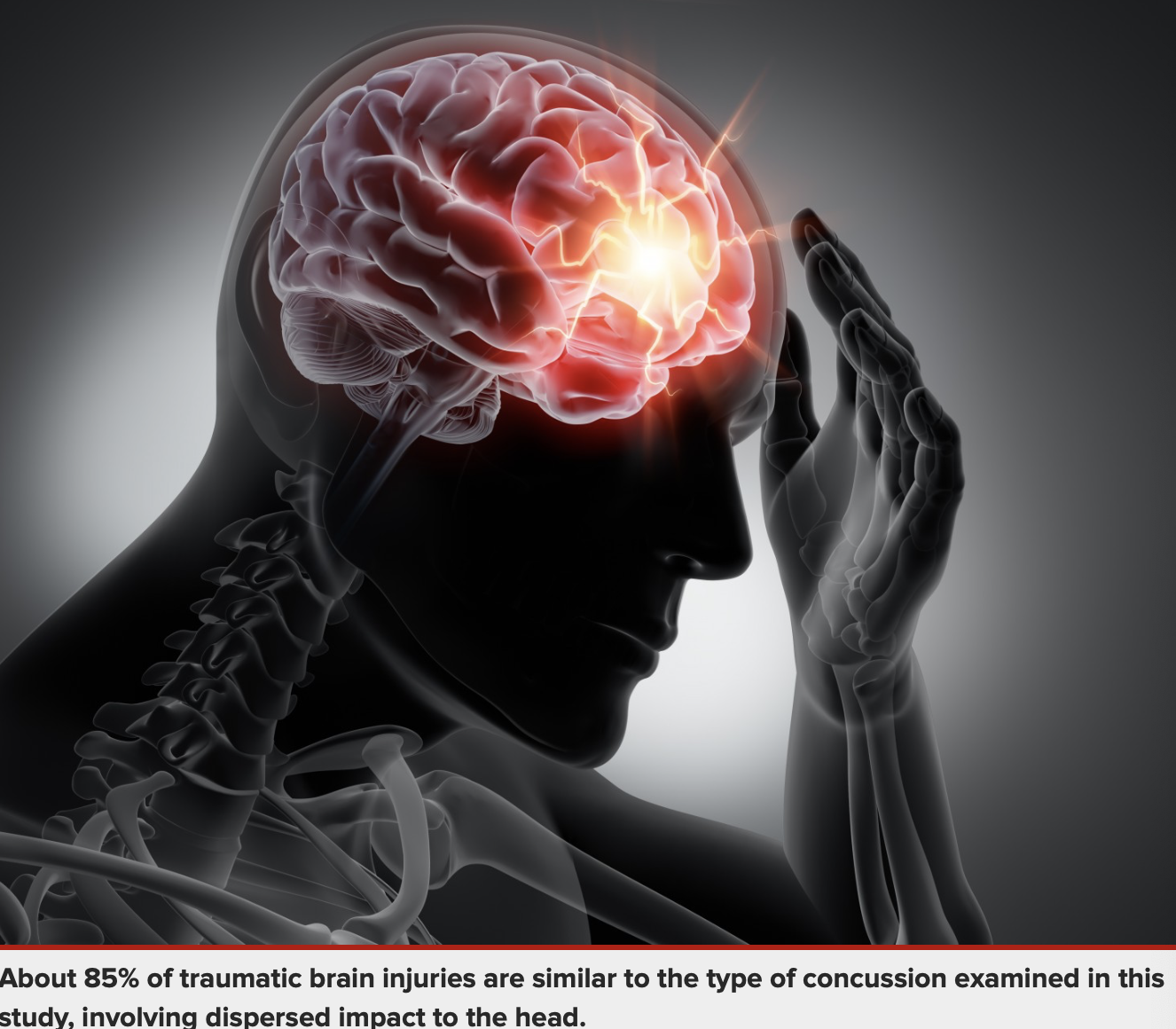 About 85% of traumatic brain injuries are similar to the type of concussion examined in this study, involving dispersed impact to the head.