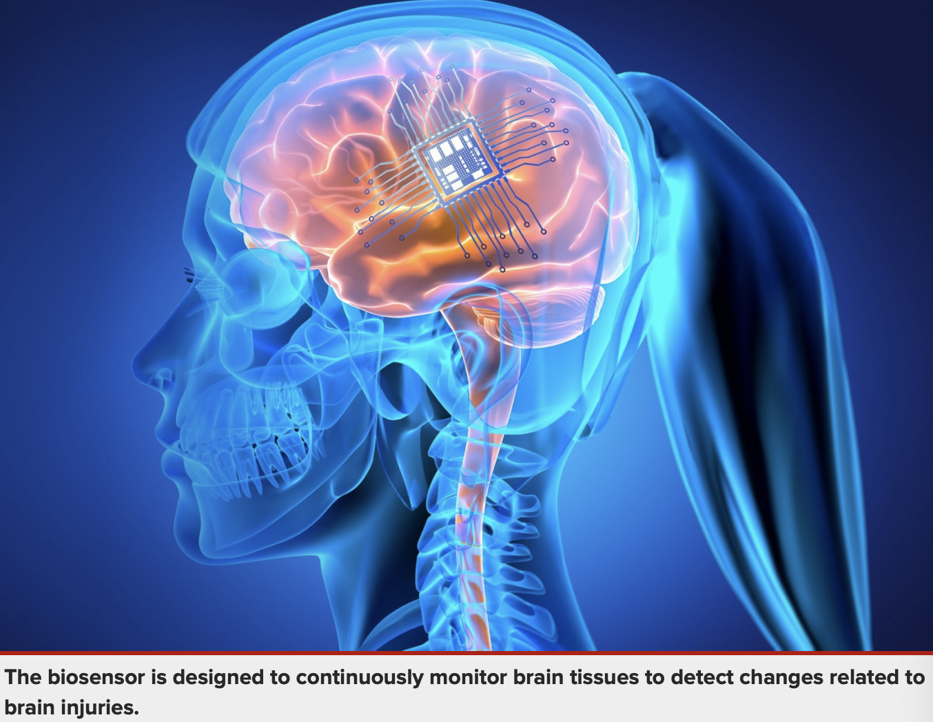 The biosensor is designed to continuously monitor brain tissues to detect changes related to brain injuries.