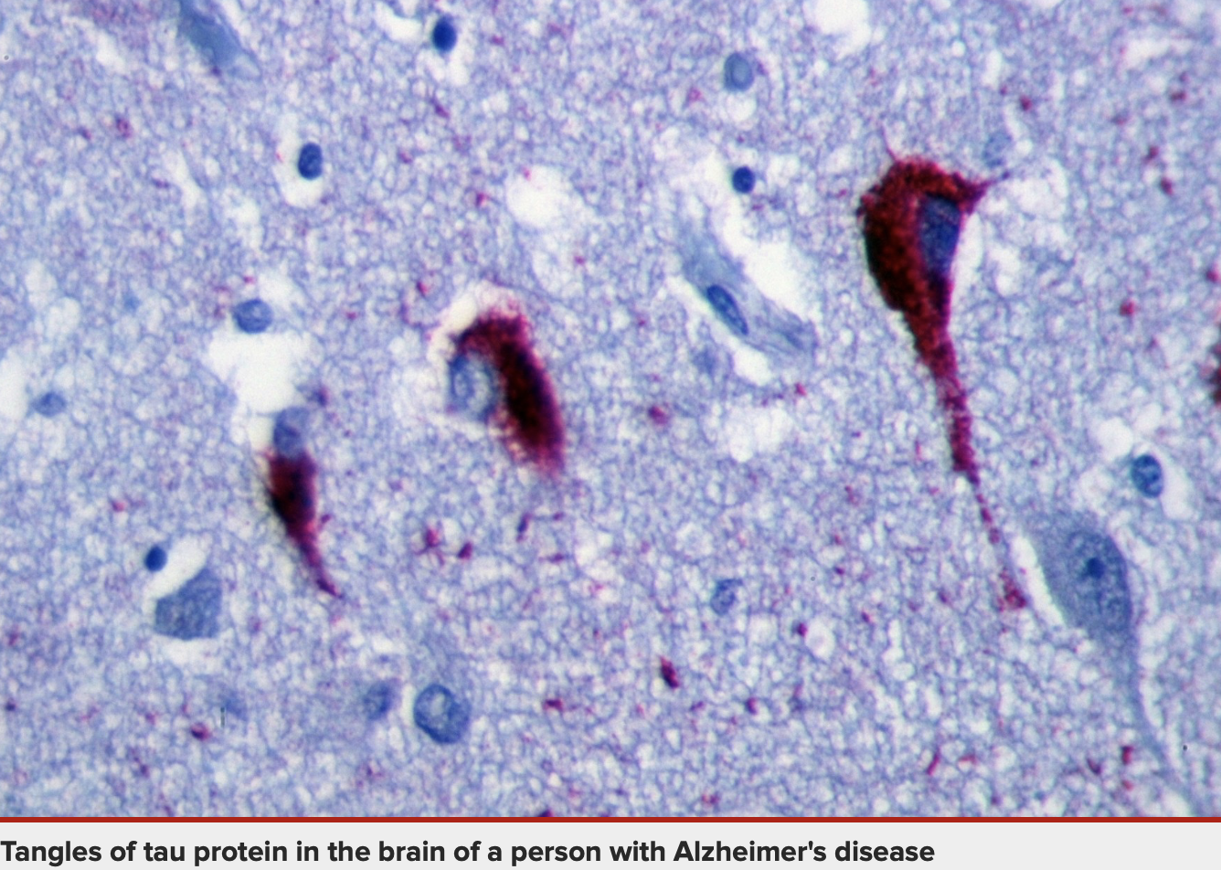 Tangles of tau protein in the brain of a person with Alzheimer's disease